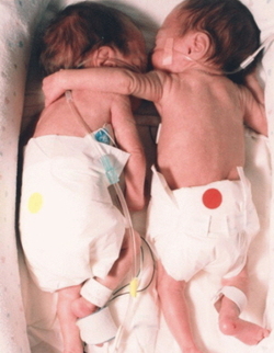 ‘생명을 구하는 포옹 (The Rescuing Hug)’이라는 제목이 붙은  이 한 장의 사진은  전 세계인을 감동시켰습니다. 카이리와 브리엘은 매사추세스  메모리얼 병원에서 예정일보다 12주 일찍 태어났습니다. 두 아이는 1kg도 안 되는  조산아로 태어나 각각 다른